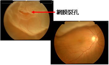 原因 網膜 剥離